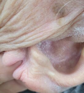 Foto de orelha rasgada ou fissurada, antes de uma lobuloplastia.