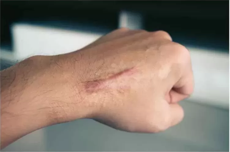 Foto de uma cicatriz hipertrófica na mão de uma pessoa.