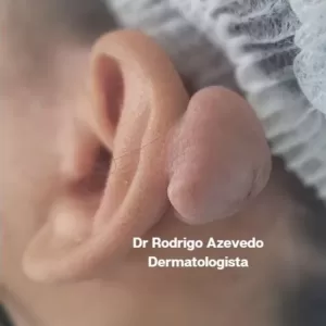 Foto de um queloide na helice de orelha, antes da cirurgia